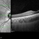 Macular OCT in Right Optic Disc Pit Macular OCT in Right Optic Disc Pit