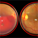 Subhyaloid Hemorrhage Subhyaloid Hemorrhage