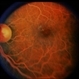 Hyperlipidemia