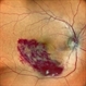BRANCH RETINAL VEIN OCCLUSION BRANCH RETINAL VEIN OCCLUSION