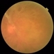 Branch Retinal Vein Occlusion-Posterior Hyaloid Proliferation