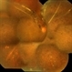 Spontaneously Reattached Retina Spontaneously Reattached Retina
