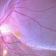 Retinal Detachment