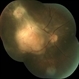 Tubercular Choroidal Granuloma Tubercular Choroidal Granuloma