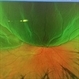 Retinal Detachment