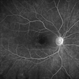 Hydroxychloroquine Maculopathy Hydroxychloroquine Maculopathy