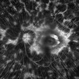 Retinitis Pigmentosa Retinitis Pigmentosa
