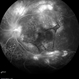 Multifocal Exudative Detachments Due to VKH Multifocal Exudative Detachments Due to VKH