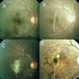 Serial Photographs of a Young Boy With Choroidal Rupture Progressing to Secondary CNVM Serial Photographs of a Young Boy With Choroidal Rupture Progressing to Secondary CNVM