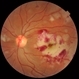 Acute Idiopathic Occlusive Retinal Vasculitis Acute Idiopathic Occlusive Retinal Vasculitis