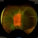 Choroidal Effusion Choroidal Effusion