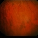 Idiopathic Pre-Retinal Membrane / Vitritis Idiopathic Pre-Retinal Membrane / Vitritis