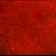 Macular Hole Evolving / Lamellar Hole Macular Hole Evolving / Lamellar Hole