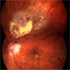 Retinal Hemorrhage
