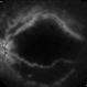 Late FA Phase of Macular Infarction Secondary to Subconjunctival Gentamicin Injection Late FA Phase of Macular Infarction Secondary to Subconjunctival Gentamicin Injection