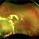 Retinal Vasoproliferative Tumor