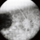 Leber's Congenital Amaurosis