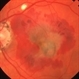 Histo and Subfoveal Neovascular Membrane Histo and Subfoveal Neovascular Membrane