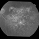 Adult Coats' Disease