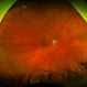 Branch Retinal Artery Occlusion