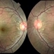 Malattia Leventinese Malattia Leventinese