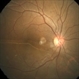 Retinal Detachment Sparing Fovea By Microns Retinal Detachment Sparing Fovea By Microns