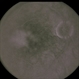 Juxtafoveal Telangiectasis / DM / Diabetes