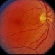 Scleritis with Chorioretinal Folds Scleritis with Chorioretinal Folds