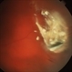 Intraocular Foreign Body Intraocular Foreign Body