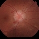 Severe Papilledema Severe Papilledema