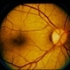Oguchi Disease Oguchi Disease
