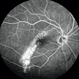 Tilted Disc Syndrome Complicated with RPE Atrophy and Polypoidal Choroidal Vasculopathy Tilted Disc Syndrome Complicated with RPE Atrophy and Polypoidal Choroidal Vasculopathy