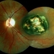 Macular Coloboma With Macular Dystrophy Macular Coloboma With Macular Dystrophy