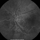 Familial Retinal Artery Tortuosity Familial Retinal Artery Tortuosity