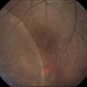 Retinoschicis Retinoschicis