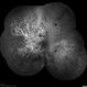 Central Retinal Vein Occlusion with Severe Ischemia