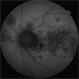 Chronic Multifocal Central Serous Chorio-Retinopathy Chronic Multifocal Central Serous Chorio-Retinopathy