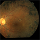 Unilateral Retinitis Pigmentosa Unilateral Retinitis Pigmentosa