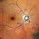 Proliferative diabetic retinopathy