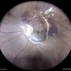 Choroidal Rupture With Traumatic Subretinal Hemorrhage