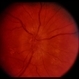 Congenital Disc Anomaly Congenital Disc Anomaly
