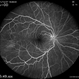 Hemi Central Retinal Artery Occlusion Hemi Central Retinal Artery Occlusion