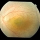 Posterior Microphthalmos
