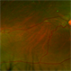 Retinal Capillary Hemangioma Retinal Capillary Hemangioma