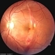 Choroidal rupture Choroidal rupture