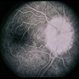 Congenital Disc Anomaly Congenital Disc Anomaly