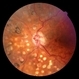Central Retinal Vein Occlusion