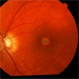 Adult Foveomacular Vitelliform Dystrophy Adult Foveomacular Vitelliform Dystrophy