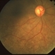 Syphilitic Chorioretinitis Syphilitic Chorioretinitis