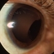 Ciliary Body Melanoma Ciliary Body Melanoma